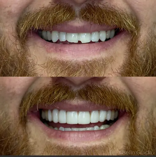 Composite veneers for natural smile enhancement