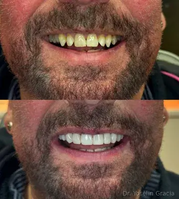 Cosmetic smile makeover treatment by Dr. Yoselin Gracia