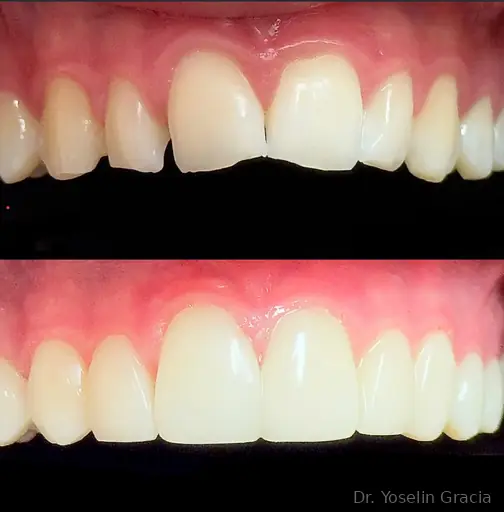 Smile design before and after result
