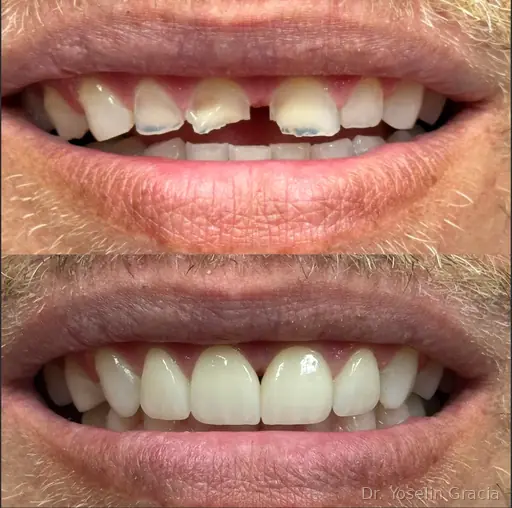 Cosmetic teeth whitening treatment