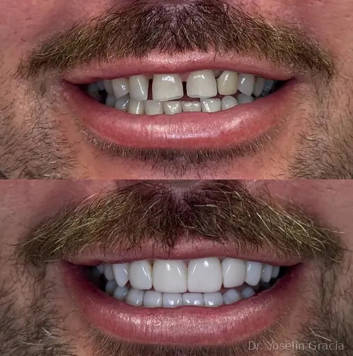 Smile brightening before and after result