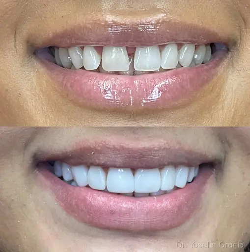 Composite bonding before and after smile result