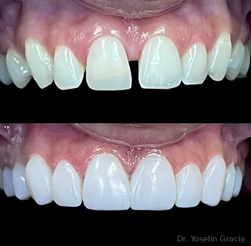 Smile makeover before and after result