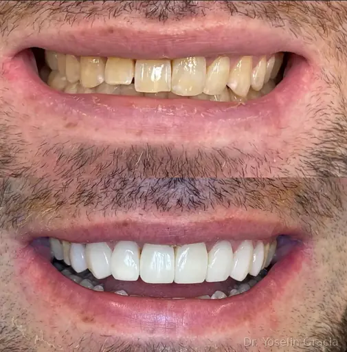 Teeth whitening before and after result