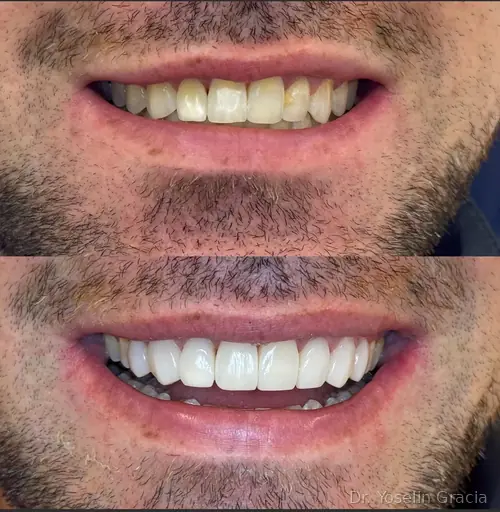 Smile design before and after result