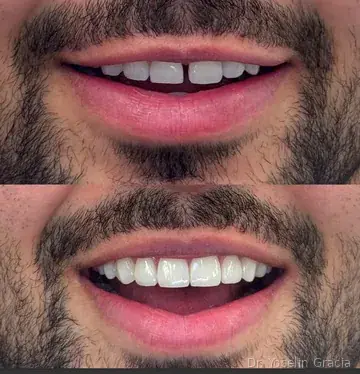 Smile brightening before and after result