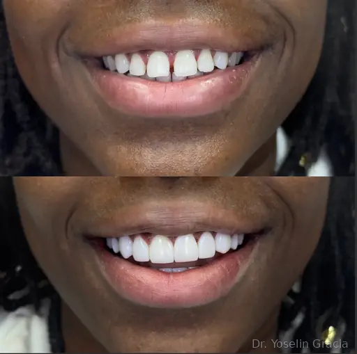 Composite bonding in London for natural tooth reshaping
