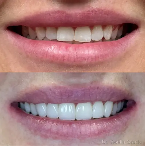 Cosmetic edge bonding for chipped tooth edges